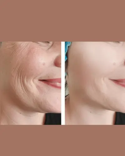 5 steps facial at home before after results
