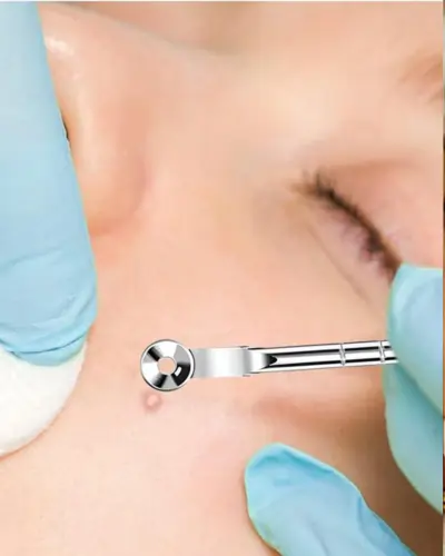 Extraction – Clears blackheads automatically