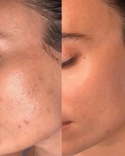 HydraFacial Before & After