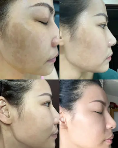 Green Peel Before and After Pictures – Real Results Green Peel Before and After Pictures – Real Results