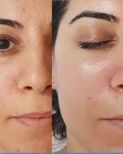 Hydrafacial Before and After 1 Treatment Face Hydrafacial Before and After 1 Treatment Face