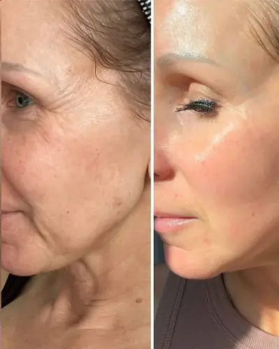 Hydrafacial eye perk before and after wrinkles Hydrafacial eye perk before and after wrinkles