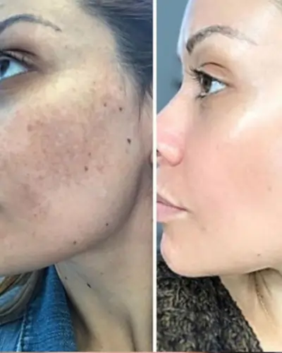 Remove dark spots on face in photo Remove dark spots on face in photo